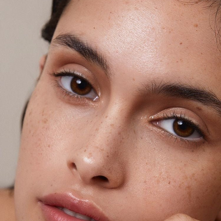 How to Manage Acne During Summer: Expert Advice on Prevention and Treatment - Skin Love Cream