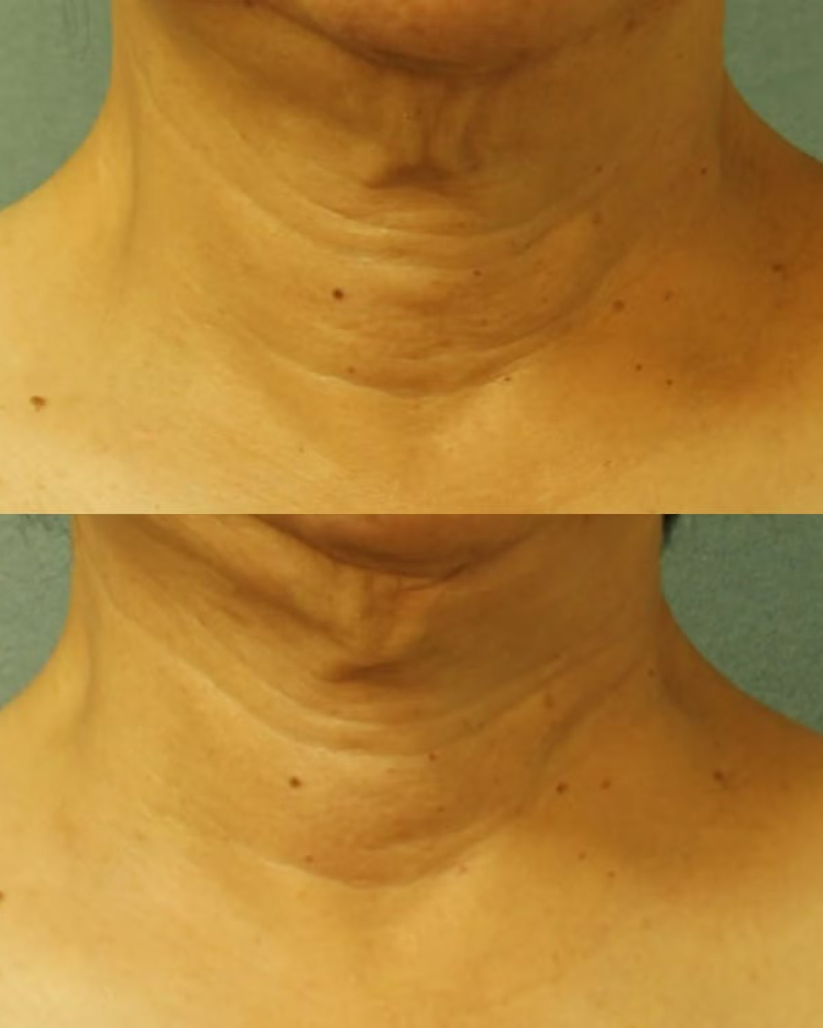 Perricone MD Cold Plasma Plus+ Neck & Chest Broad Spectrum SPF 25 - Skin Love Cream