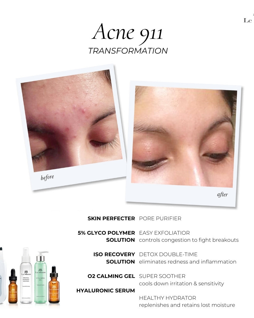 Le Mieux Acne 911 Transformation Bundle