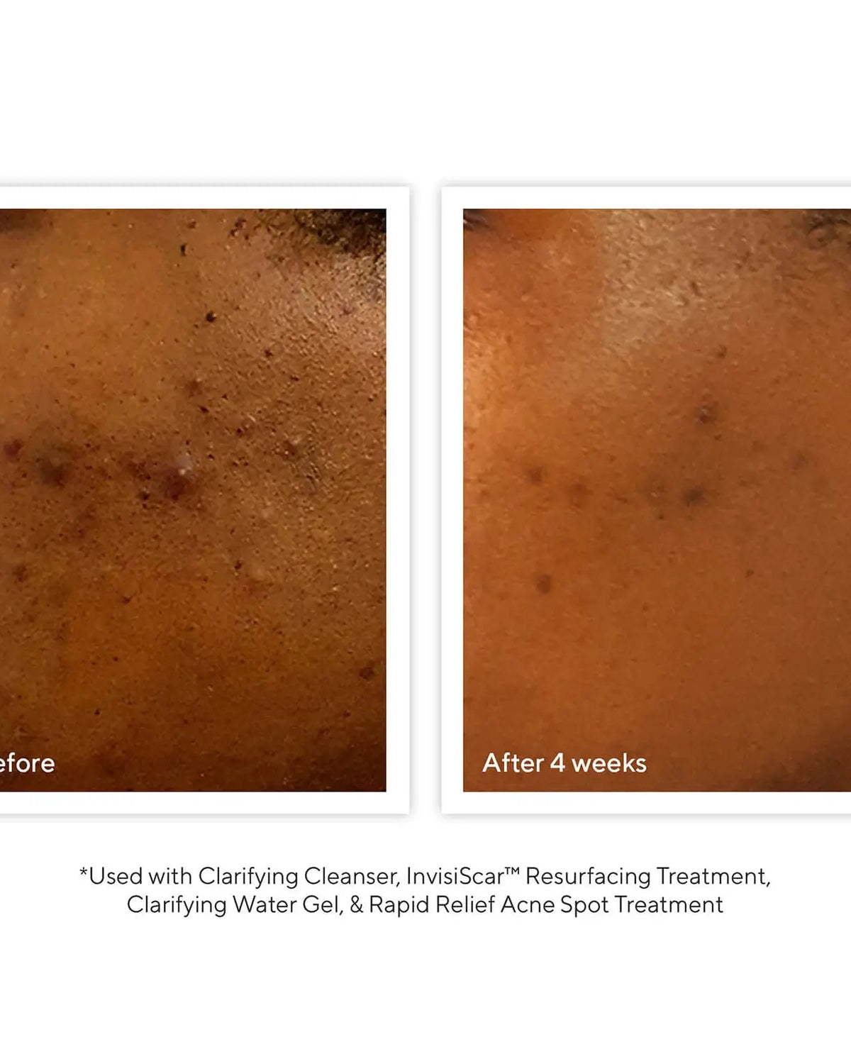 Murad Acne Control Clarifying Cleanser - Skin Love Cream