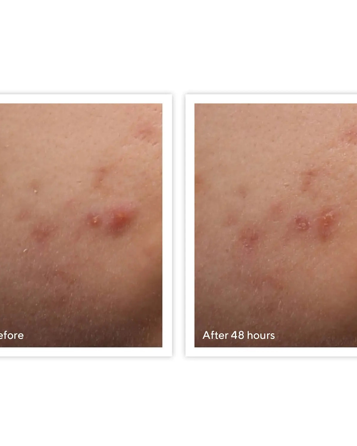 Murad Rapid Relief Acne Spot Treatment - Skin Love Cream