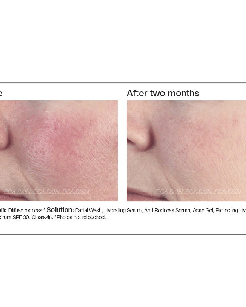 PCA Skin Anti - Redness Serum - Skin Love Cream