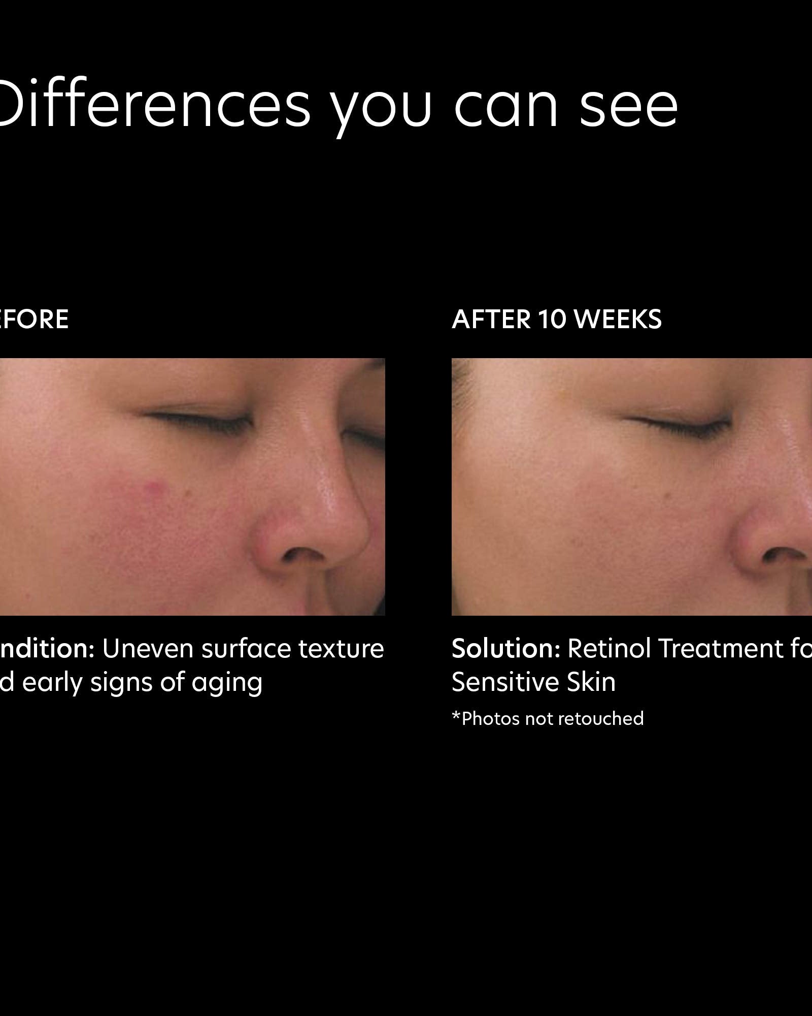 PCA Skin Retinol Treatment for Sensitive Skin - Skin Love Cream