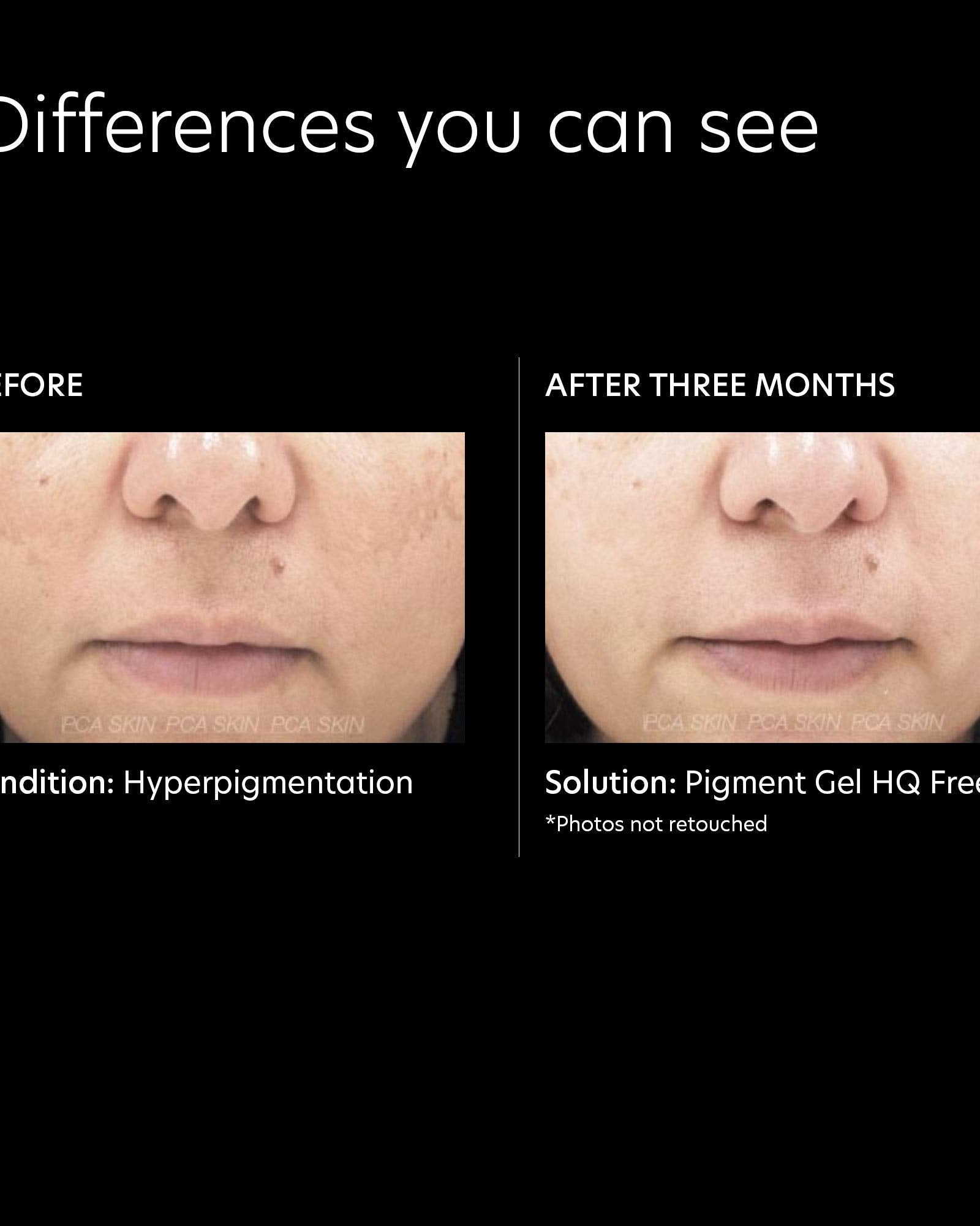 PCA Skin Pigment Gel HQ Free - Skin Love Cream