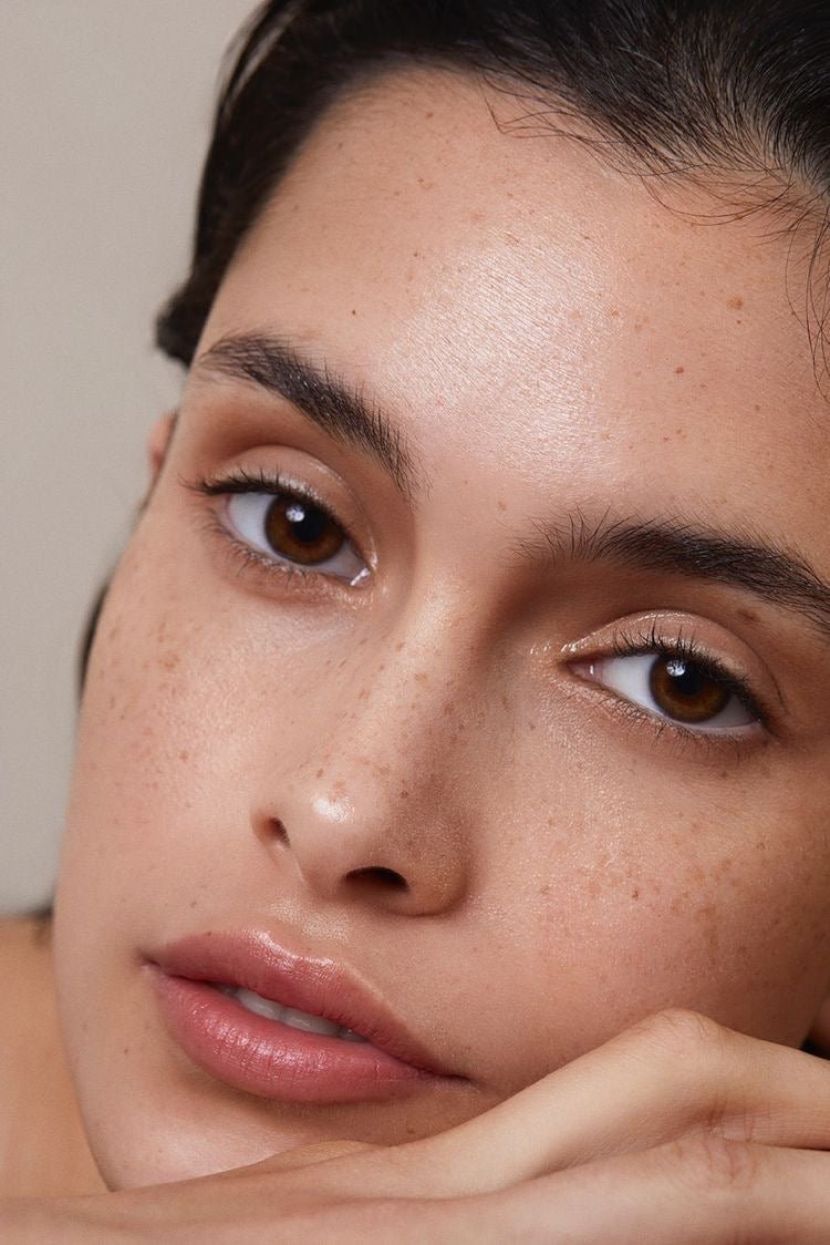 How to Manage Acne During Summer: Expert Advice on Prevention and Treatment - Skin Love Cream