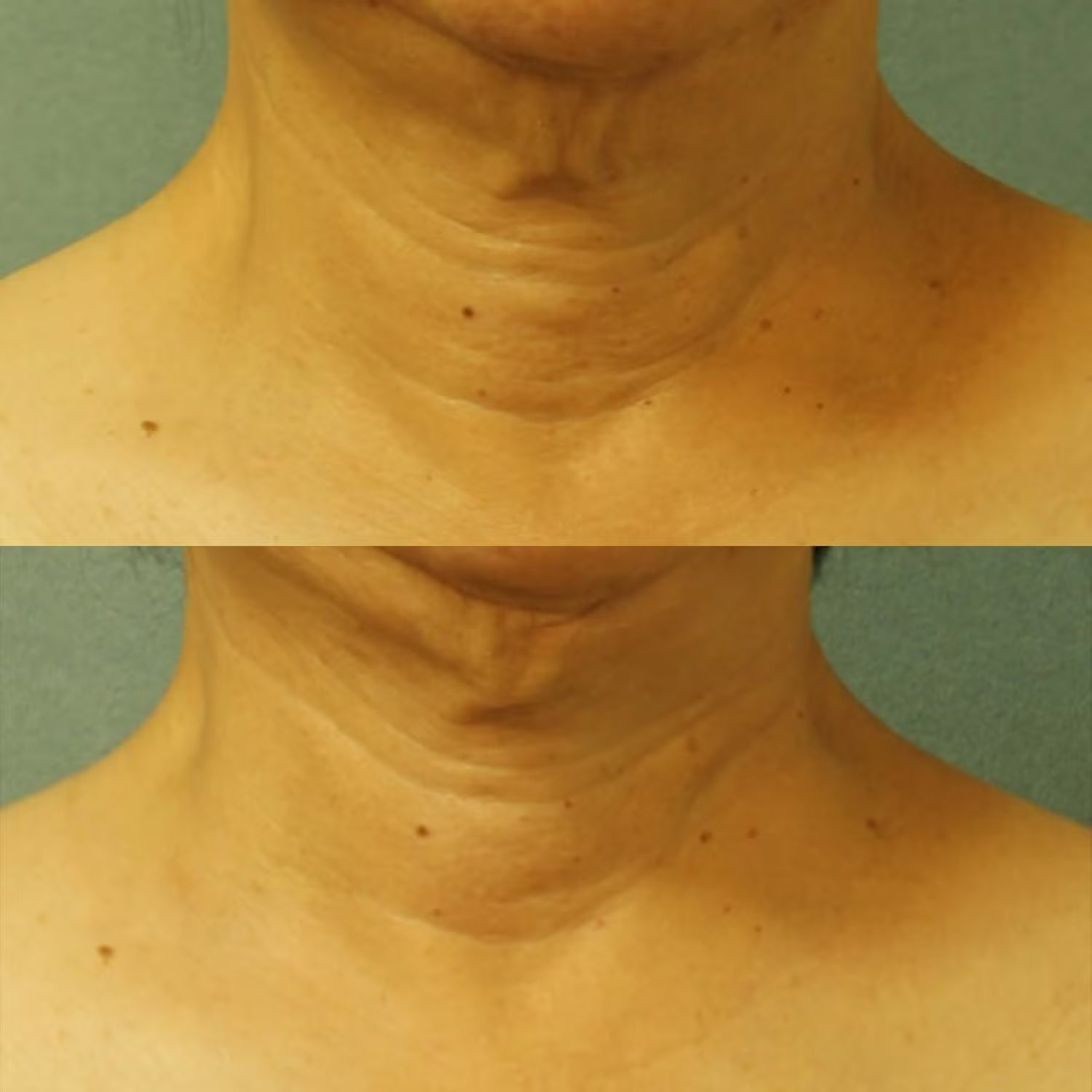 Perricone MD Cold Plasma Plus+ Neck & Chest Broad Spectrum SPF 25 - Skin Love Cream