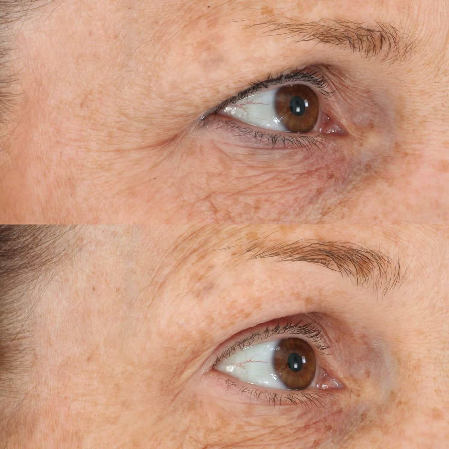 Perricone MD Essential Fx Acyl - Glutathione Eyelid Lift Serum - Skin Love Cream