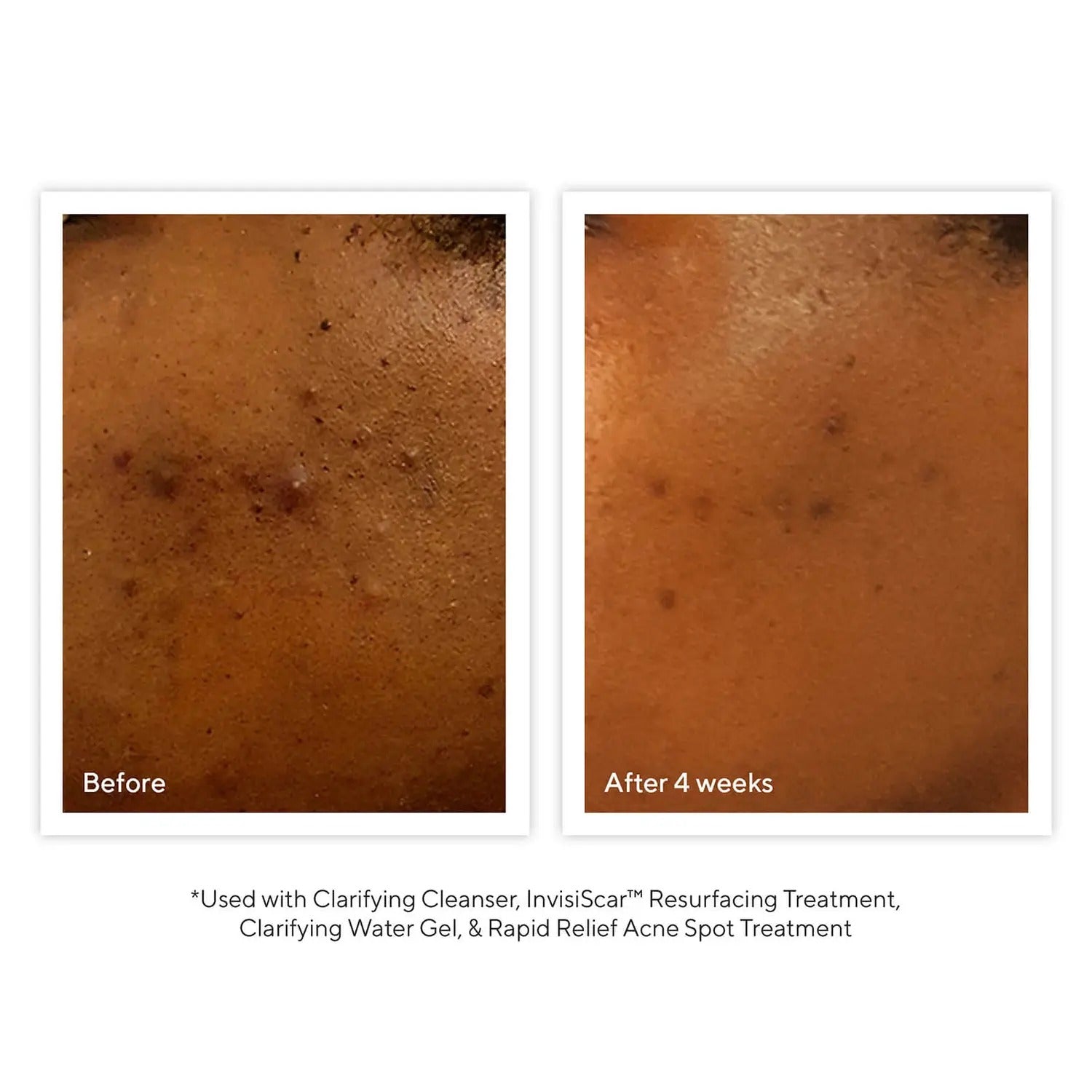 Murad Acne Control Clarifying Cleanser - Skin Love Cream