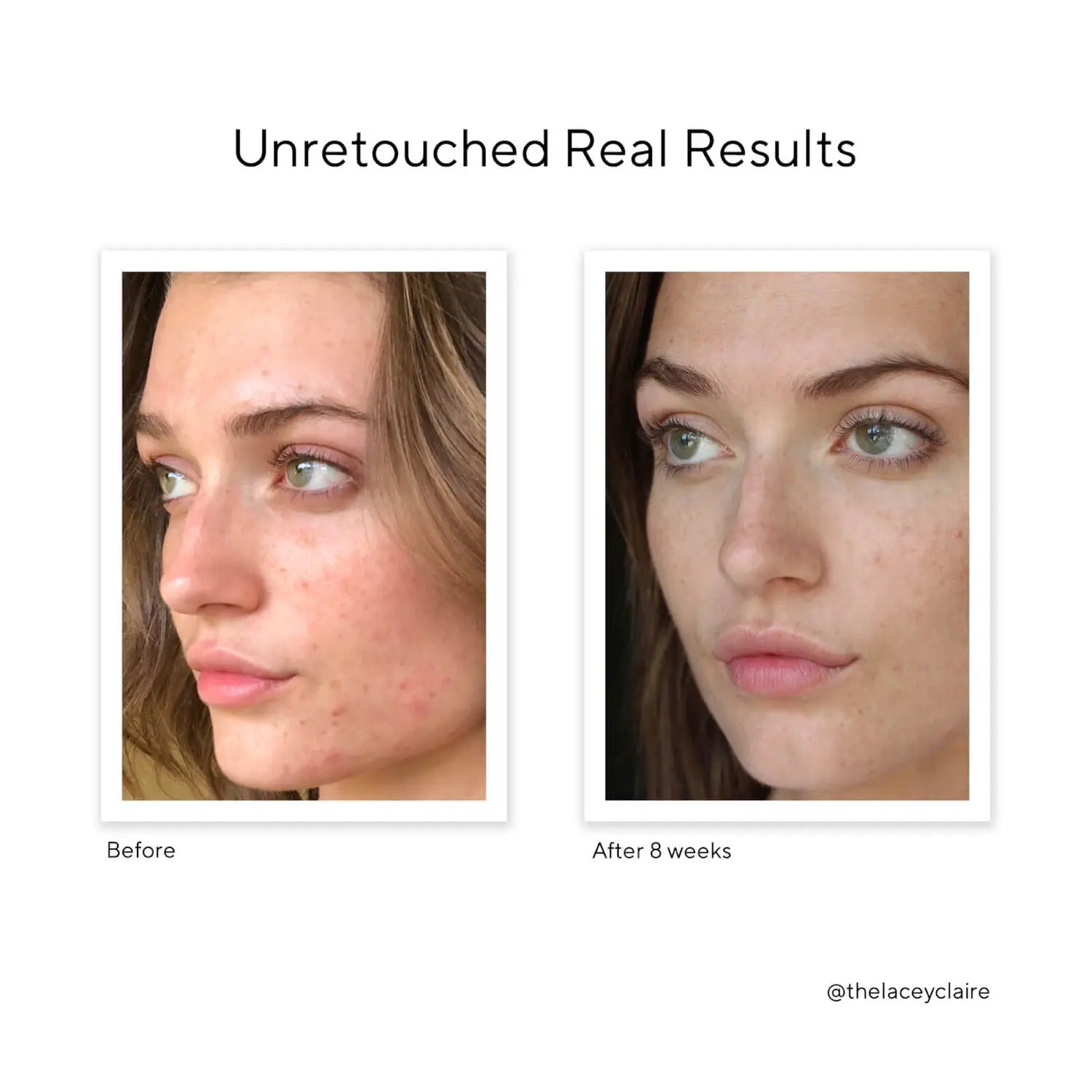 Murad Acne Control InvisiScar Resurfacing Treatment