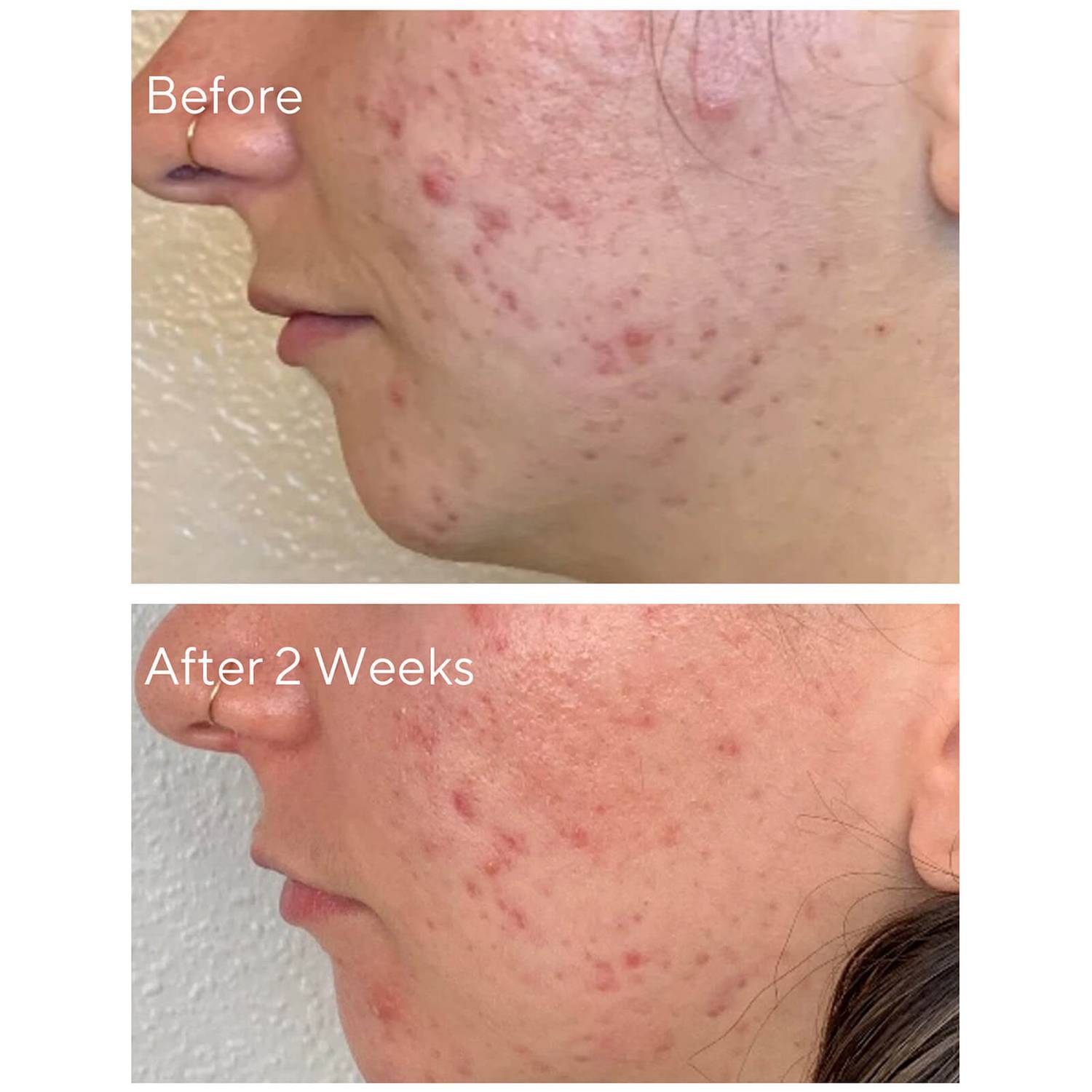 Murad AHA/BHA/Retinoid Daily Clarifying Peel - Skin Love Cream