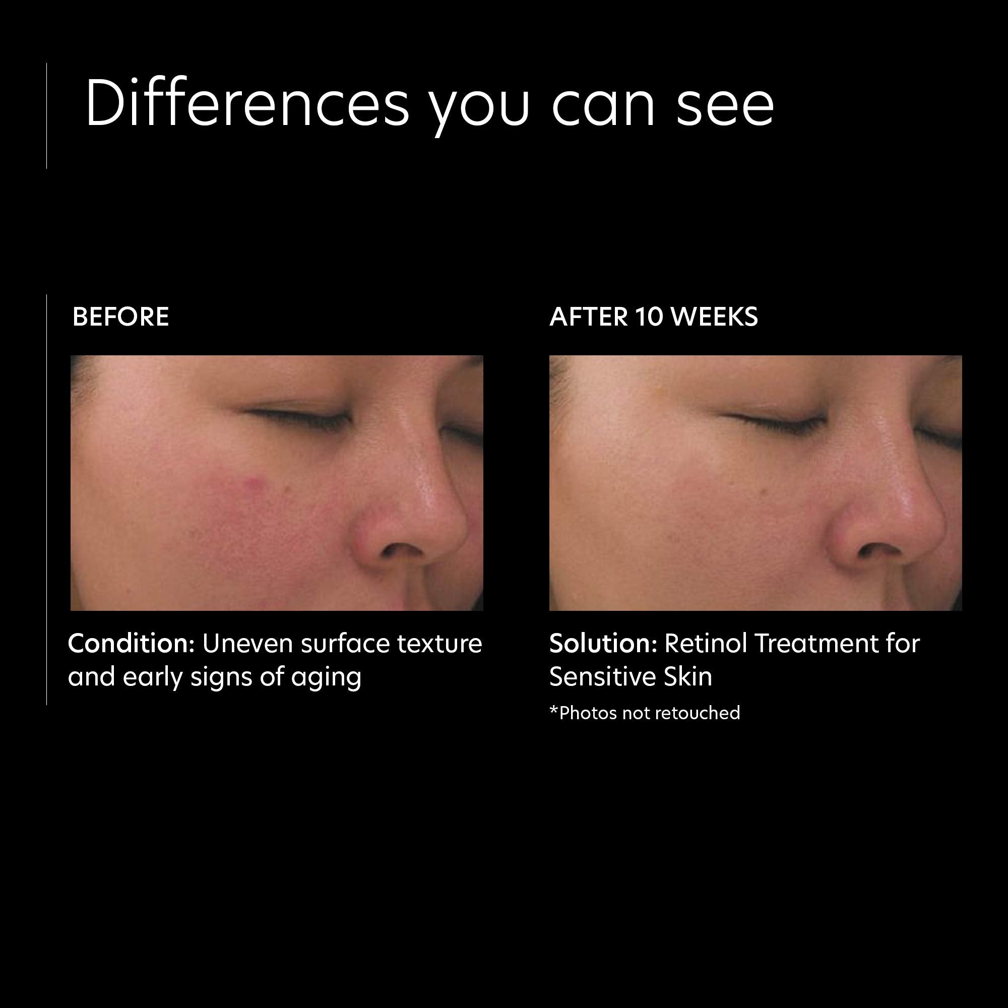 PCA Skin Retinol Treatment for Sensitive Skin - Skin Love Cream