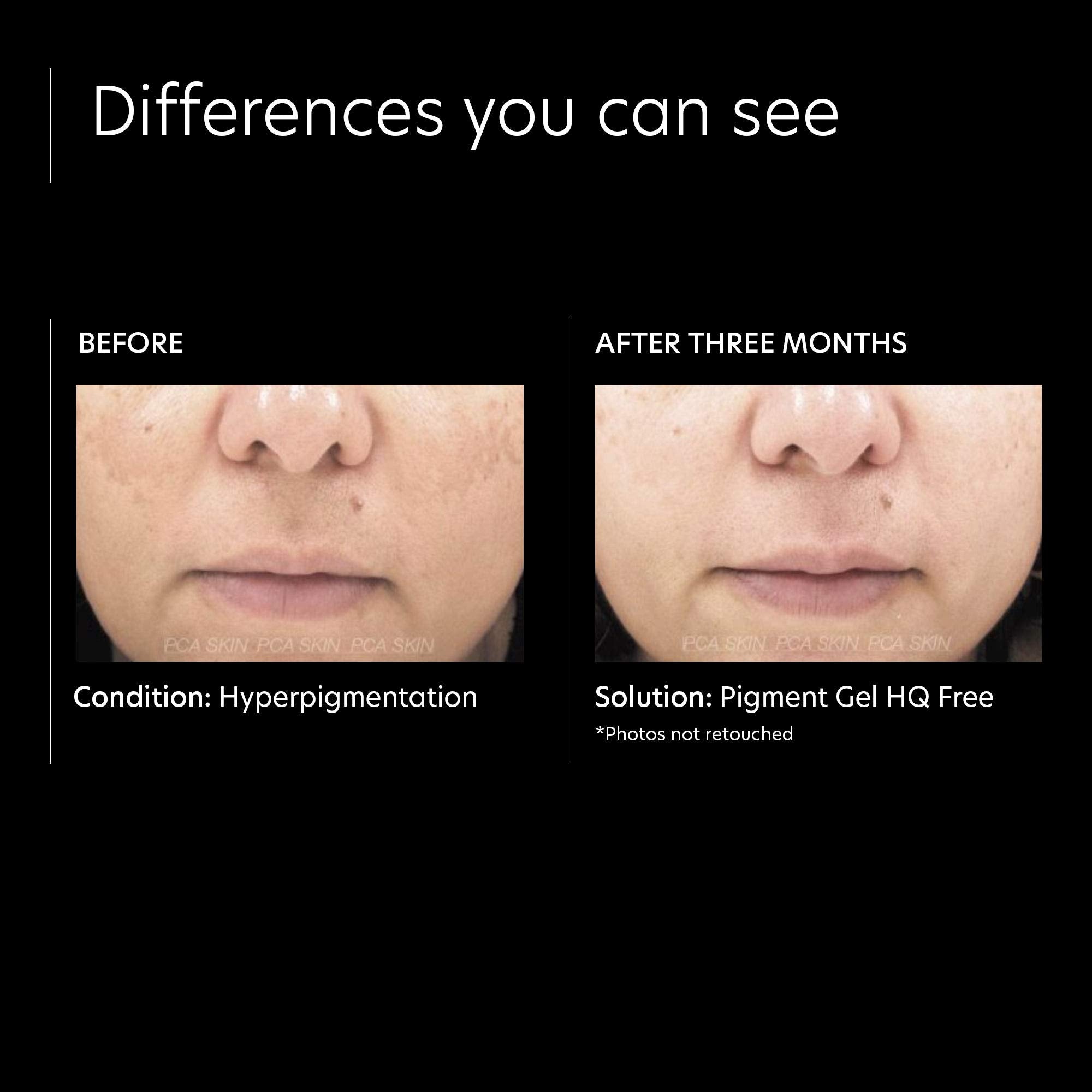 PCA Skin Pigment Gel HQ Free - Skin Love Cream