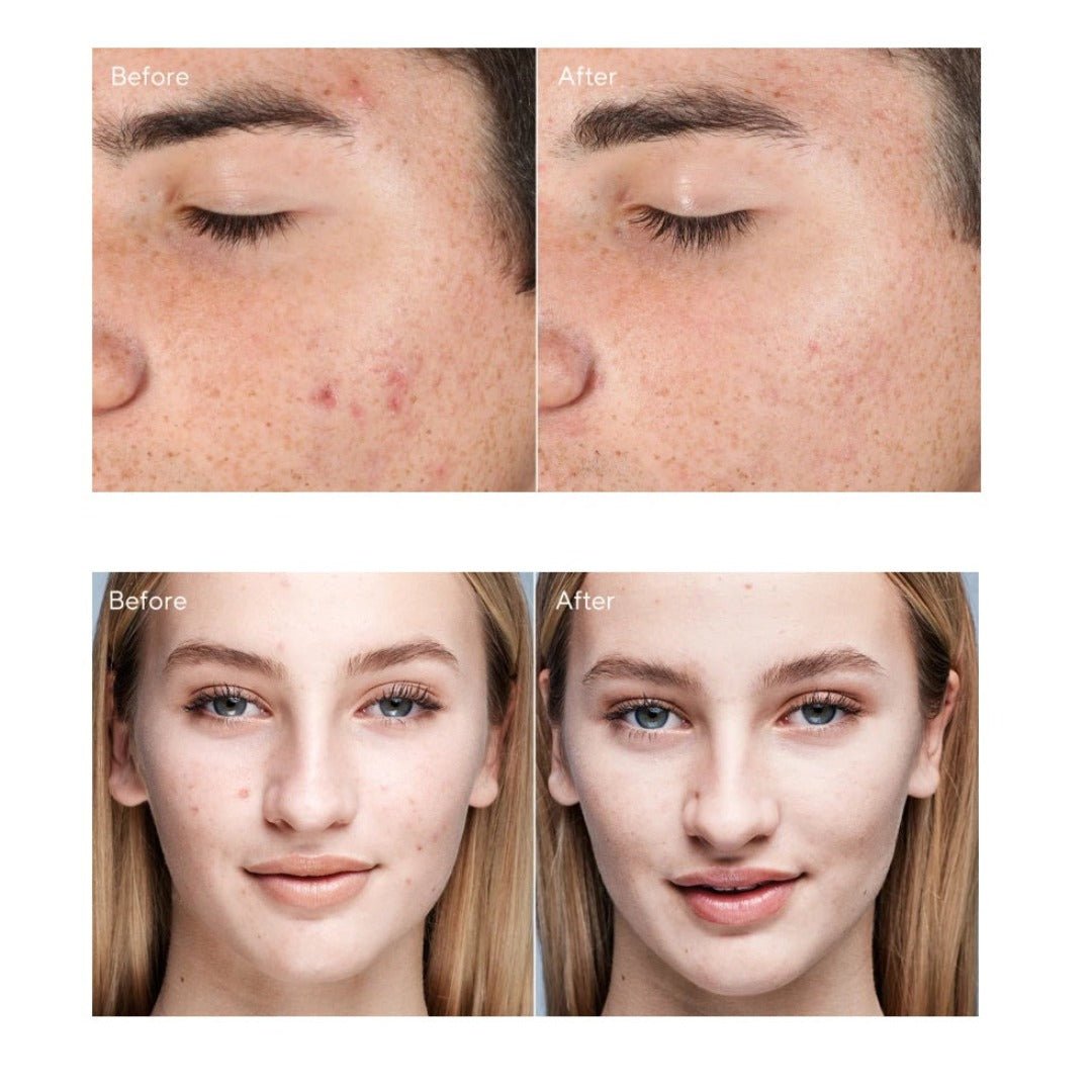 Murad Outsmart Acne Clarifying Treatment - Skin Love Cream